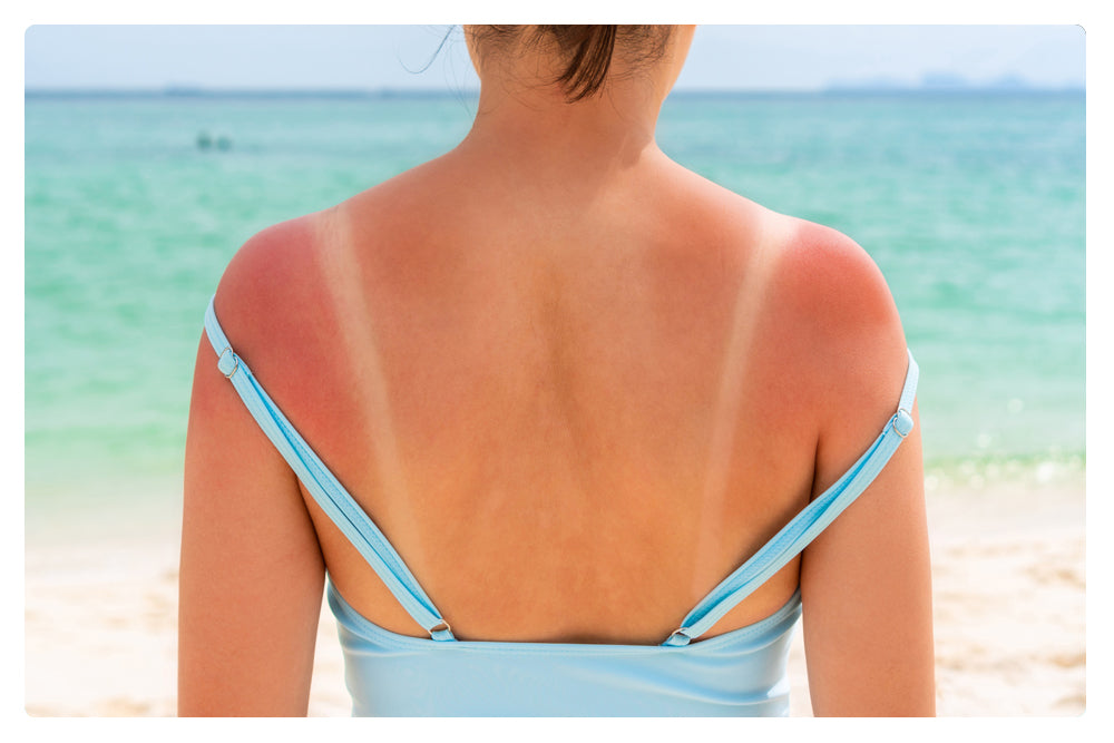 Science Behind Sunburns and How to Protect From Peeling